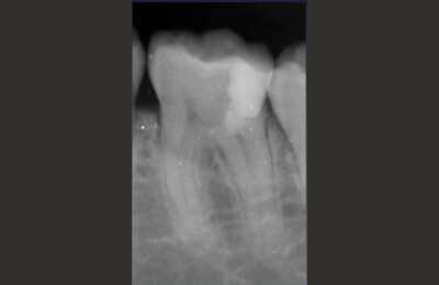 歯髄温存療法症例