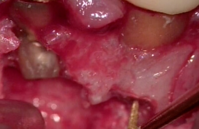 外科的歯内療法症例